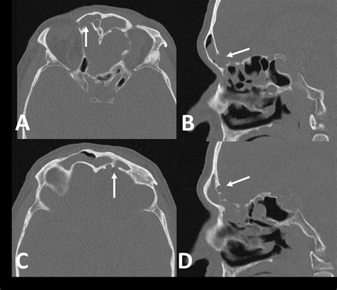 ct scan for csf leaks